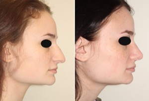 Dr. Denton Rhinoplasty before and after photo of a female patient