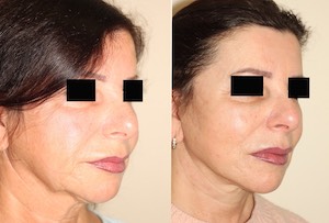 Dr. Denton facelift before and after photo of a female patient