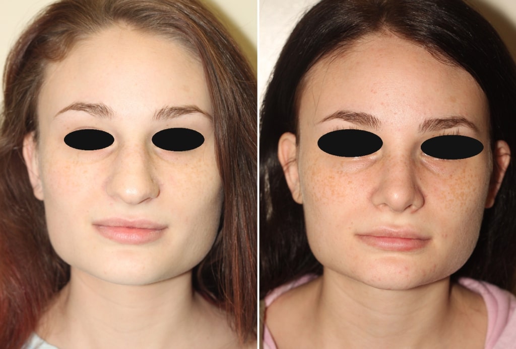 Dr. Denton Rhinoplasty before and after photo of a female patient