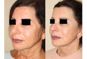 Dr. Denton facelift before and after photo of a female patient