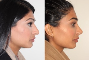 Dr. Denton Rhinoplasty before and after photo of a female patient