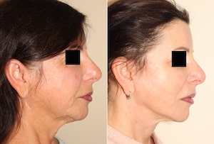 Dr. Denton facelift before and after photo of a female patient