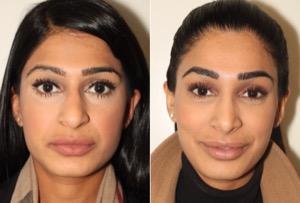 Dr. Denton Rhinoplasty before and after photo of a female patient