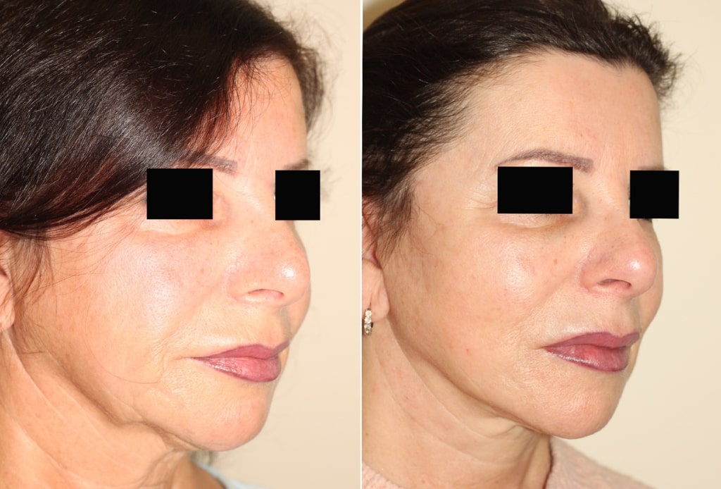 Dr. Denton facelift before and after photo of a female patient