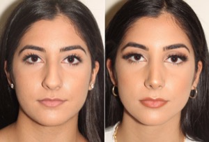 Dr. Denton Rhinoplasty before and after photo of a female patient