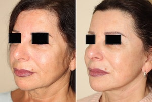 Dr. Denton facelift before and after photo of a female patient