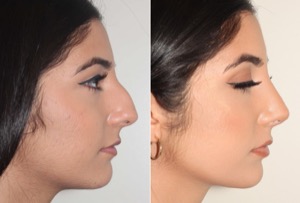 Dr. Denton Rhinoplasty before and after photo of a female patient