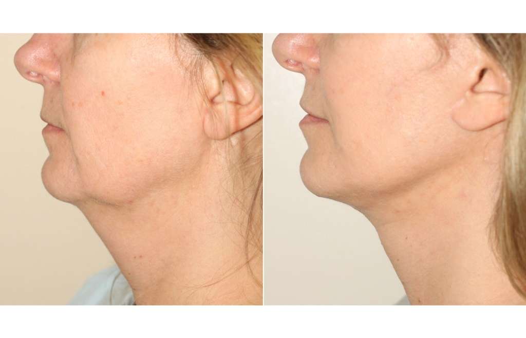 Rejuvenate Your Appearance With A Lower Facelift