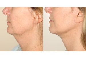 Dr. Denton facelift before and after photo of a female patient