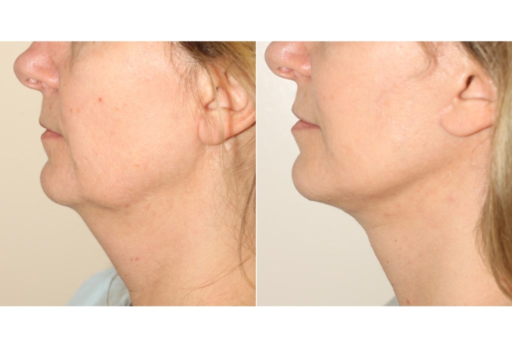 Lower Facelift Procedure - female patient before/after photo