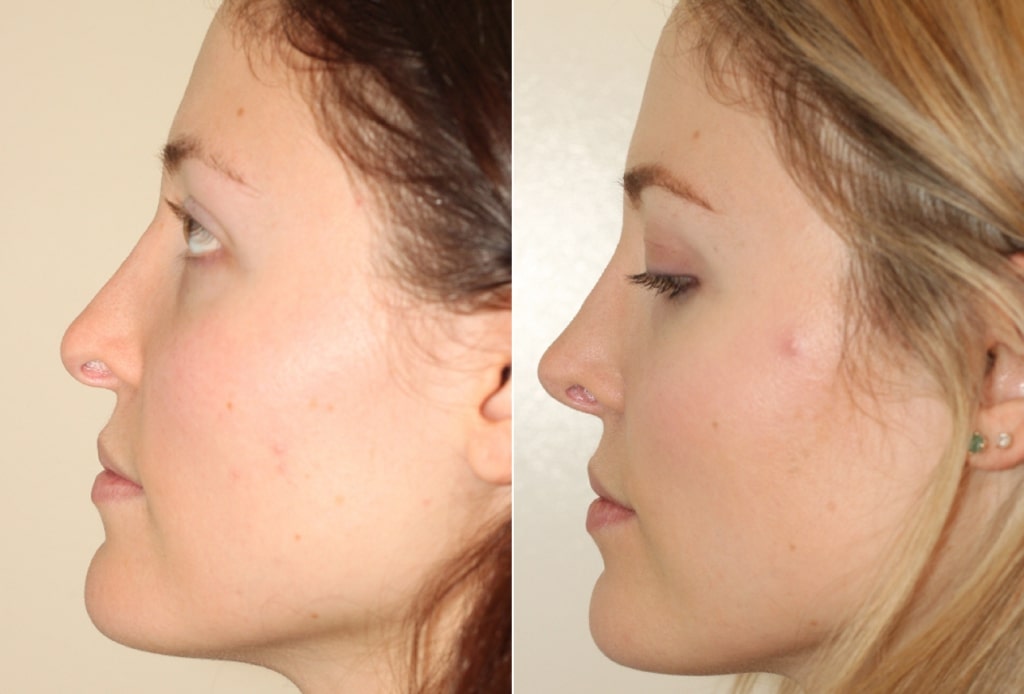 Dr. Denton Rhinoplasty before and after photo of a female patient