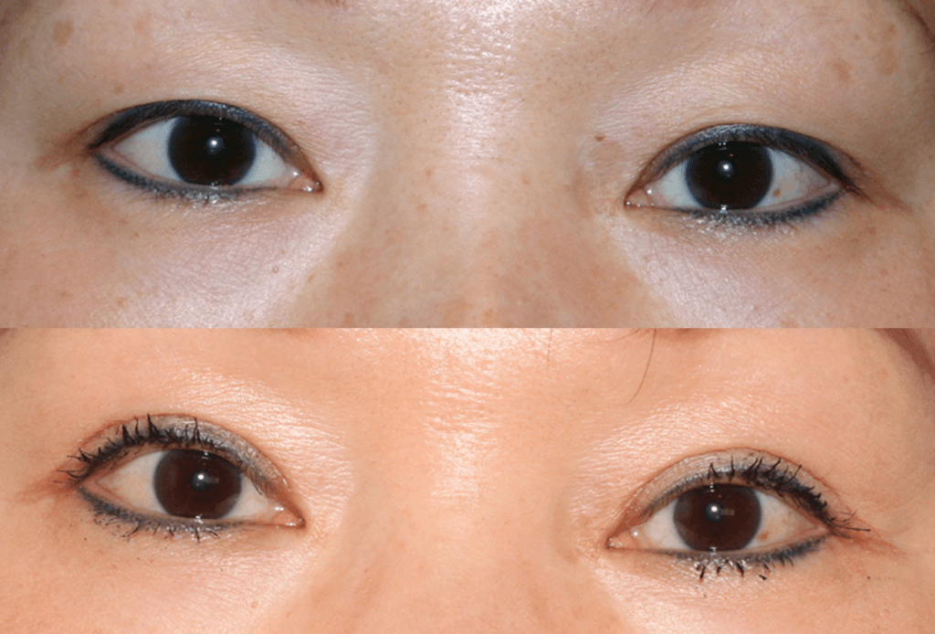 Dr. Denton Asian blepharoplasty before and after photo of a female patient