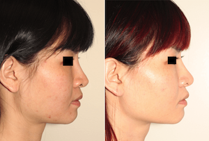 Dr. Denton Asian rhinoplasty before and after photo of a female patient