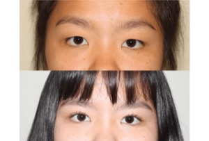 Dr. Denton Asian blepharoplasty before and after photo of a female patient