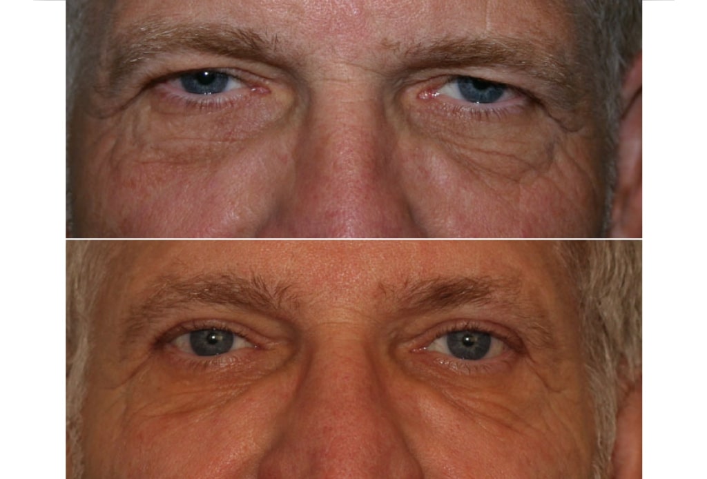 Dr. Denton browlift before and after photo of a male patient