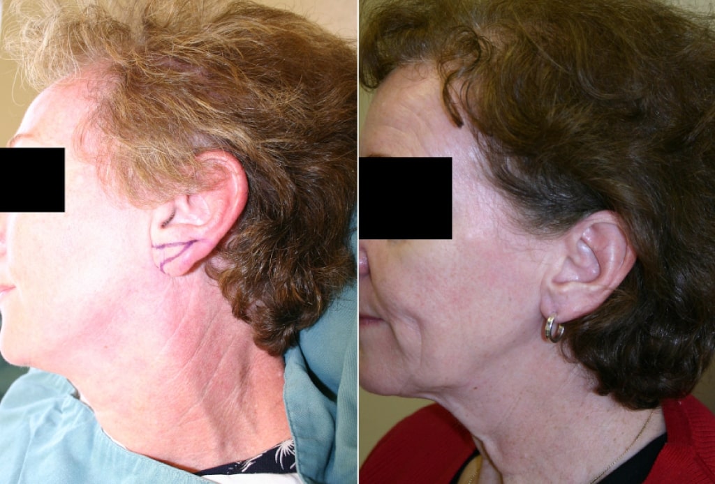 Dr. Denton Otoplasty before and after - ear lobe reduction