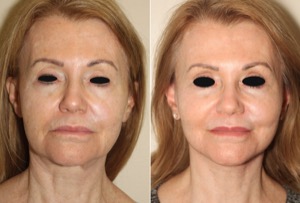 Dr. Denton facelift before and after photo of a female patient