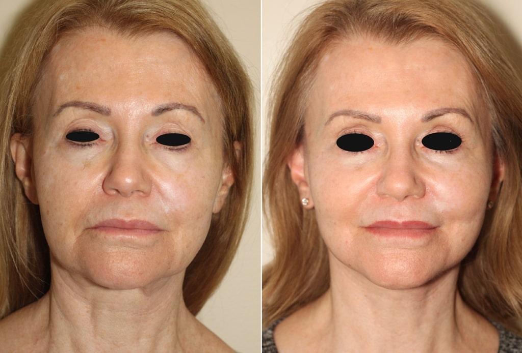 Dr. Denton facelift before and after photo of a female patient