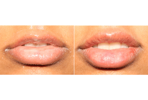 Dr. Denton lip filler before and after photo of a female patient