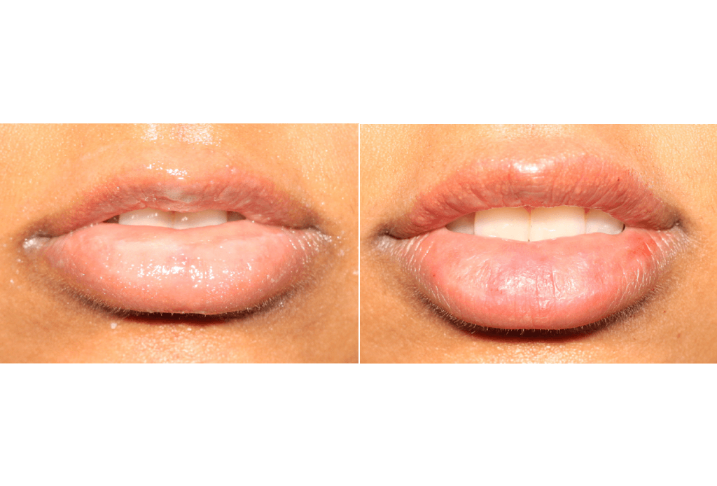 Dr. Denton lip filler before and after photo of a female patient