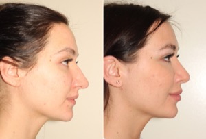 Dr. Denton Rhinoplasty before and after photo of a female patient