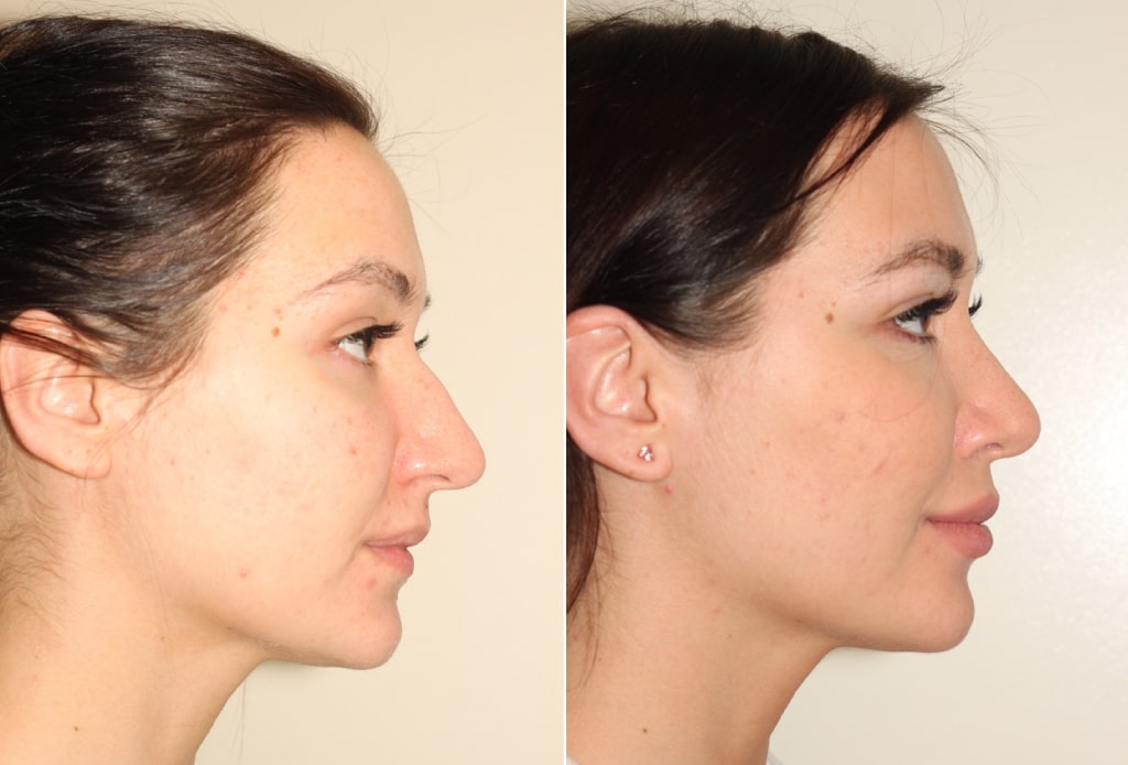 Dr. Denton Rhinoplasty before and after photo of a female patient