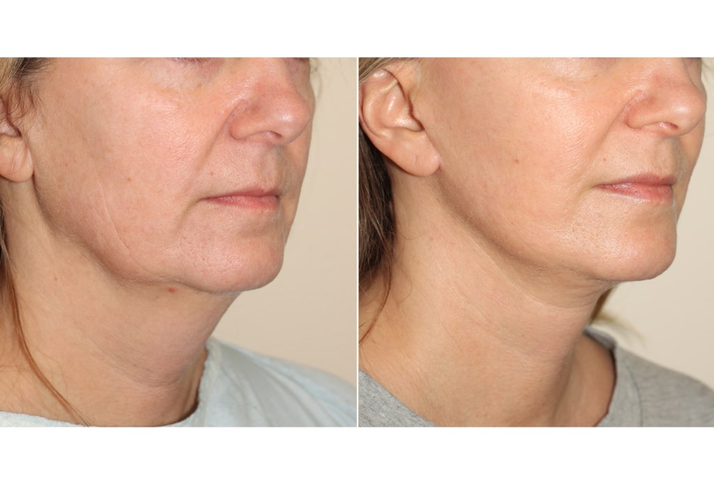 Dr. Denton facelift before and after photo of a female patient