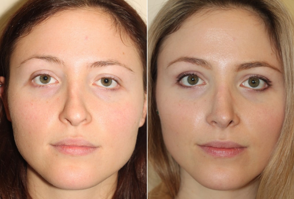 Dr. Denton Rhinoplasty before and after photo of a female patient