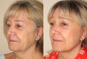 Dr. Denton facelift before and after photo of a female patient