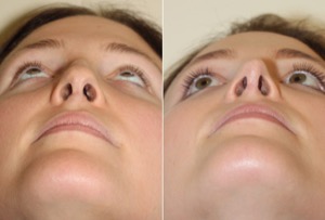 Dr. Denton Rhinoplasty before and after photo of a female patient