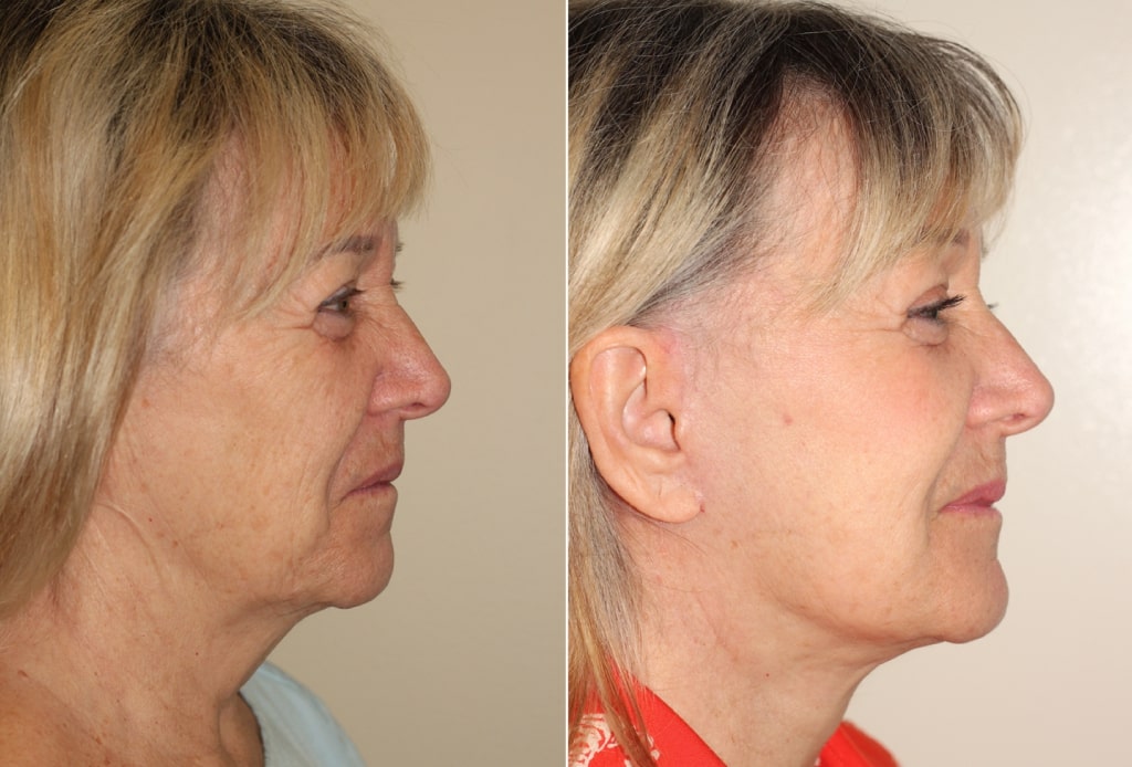 Dr. Denton facelift before and after photo of a female patient