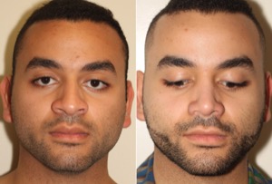 Dr. Denton Rhinoplasty before and after photo of a male patient