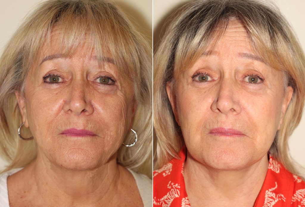 Dr. Denton facelift before and after photo of a female patient