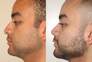 Dr. Denton Rhinoplasty before and after photo of a male patient