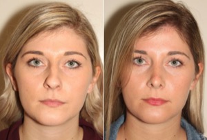 Dr. Denton Rhinoplasty before and after photo of a female patient