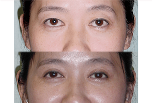 Dr. Denton Asian blepharoplasty before and after photo of a female patient