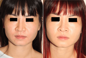 Dr. Denton Asian rhinoplasty before and after photo of a female patient
