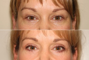 Dr. Denton blepharoplasty before and after photo of a female patient