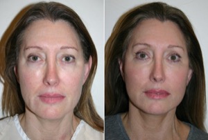 Dr. Denton browlift before and after photo of a female patient