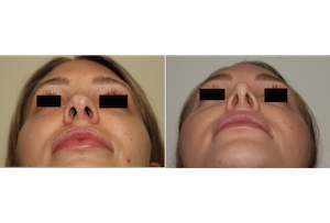 Dr. Denton rhinoplasty and chin implant before and after photo of a female patient