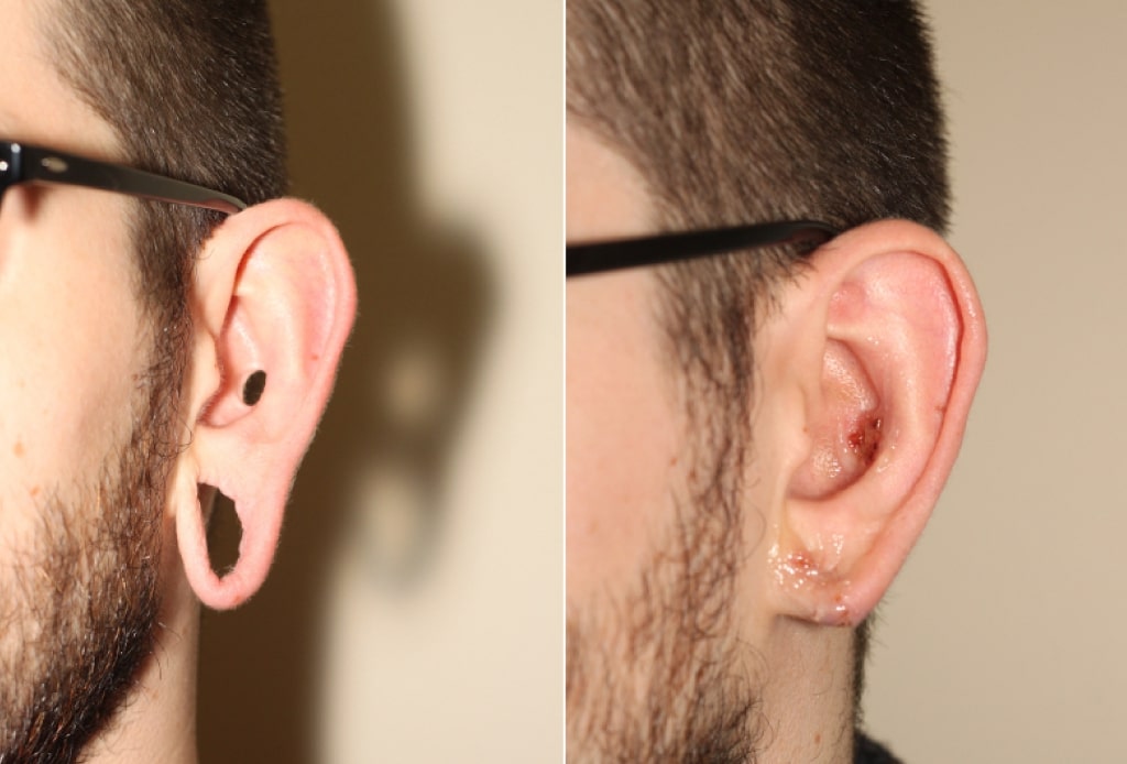 Dr. Denton Otoplasty before and after - ear lobe repair