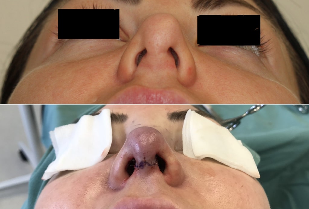 Dr. Denton Rhinoplasty before and after photo of a female patient