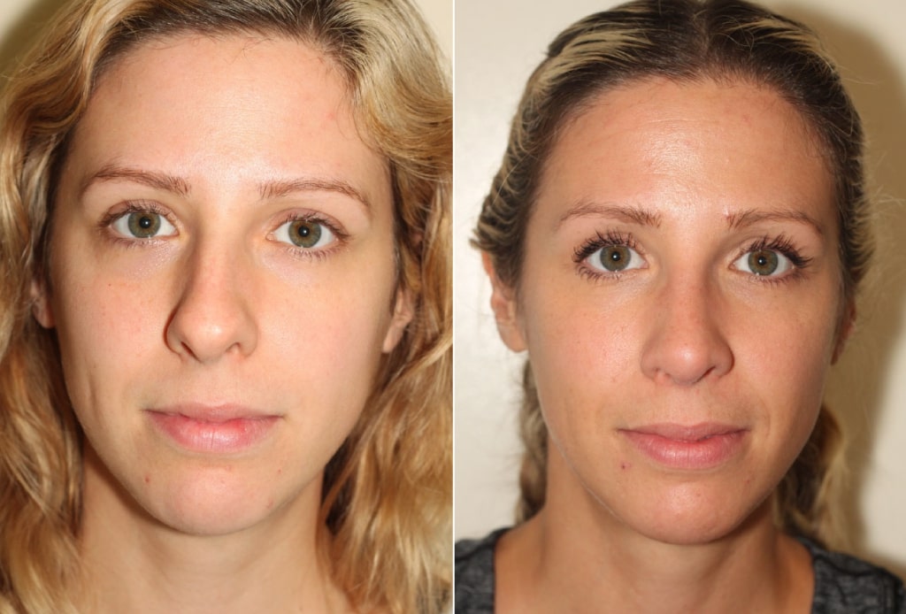 Dr. Denton Rhinoplasty before and after photo of a female patient