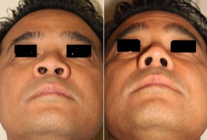 Dr. Denton Asian rhinoplasty before and after photo of a male patient