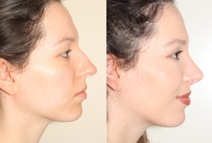 Dr. Denton Rhinoplasty before and after photo of a female patient