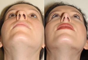 Dr. Denton Rhinoplasty before and after photo of a female patient