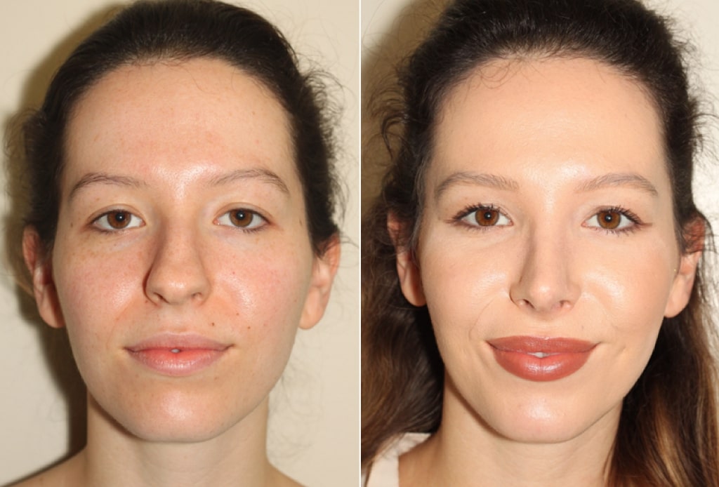 Dr. Denton Rhinoplasty before and after photo of a female patient