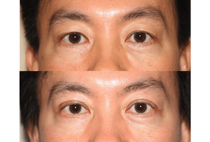 Dr. Denton Asian blepharoplasty before and after photo of a male patient