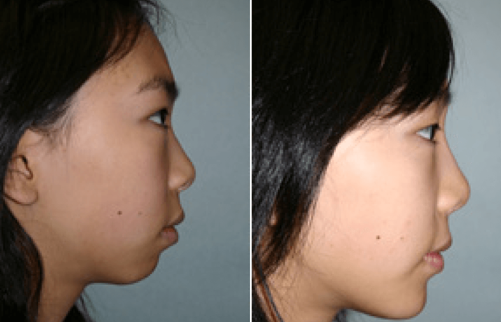 Asian Rhinoplasty In Vancouver