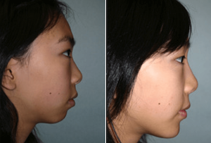 Dr. Denton Asian rhinoplasty before and after photo of a female patient